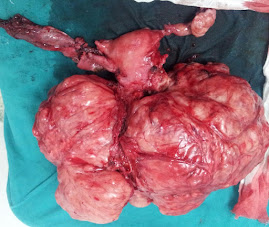 Huge cervical fibroid - TAH and BSO done by Dr. Alaa Mosbah