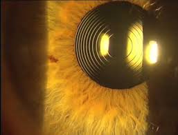 What You Need To Know Before Cataract Surgery in 2016 - Eyedolatry