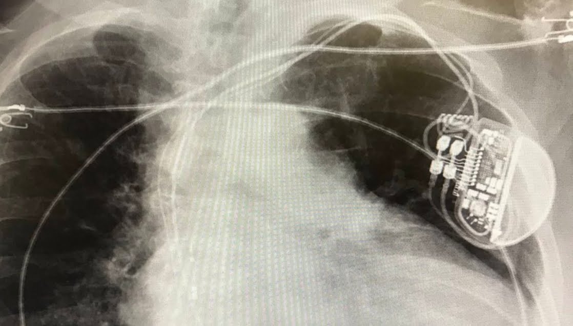 Implant Files: Indagine su pacemaker, protesi dell’anca e retine per il contenimento delle ernie.