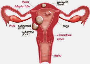 http://www.mannatfertility.com/Myomectomy.php