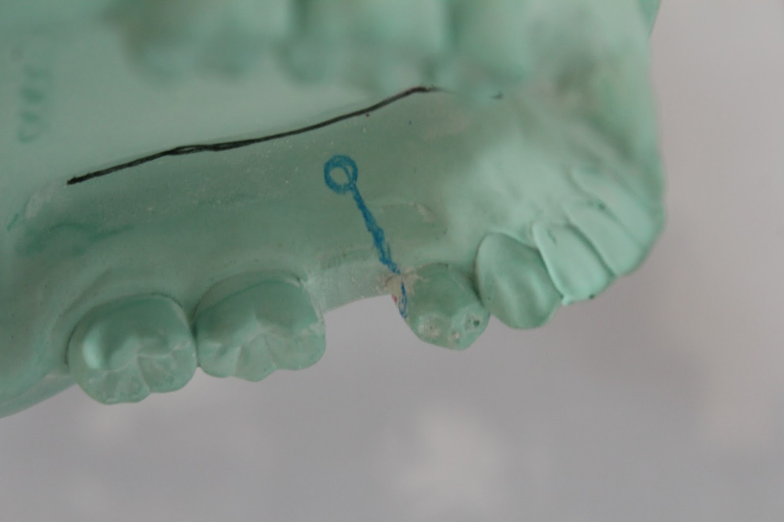 Step by step Guide for Understanding the Prosthodontics Making clasp