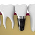 Trồng răng implant có đau và đáng sợ không?