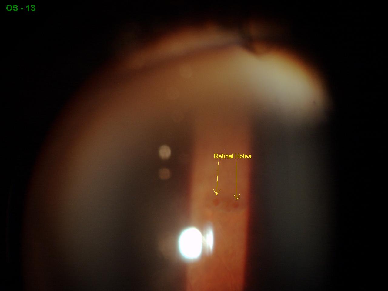 hole in retina surgery hole in retina surgery