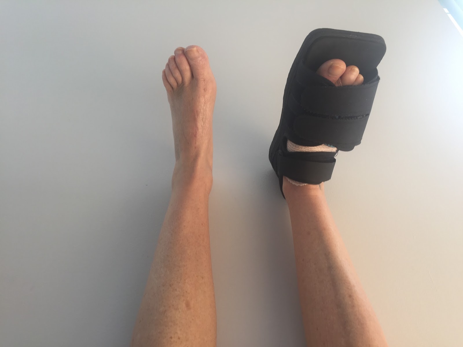 Before, During, & After Bunion Surgery... Four Weeks PostOp [second