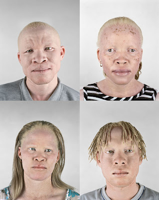 alteraciones pigmentarias