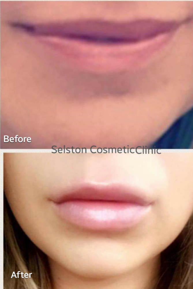 Selston Cosmetic Clinic Improve Flat & Unbalanced Lips with Lip Filler