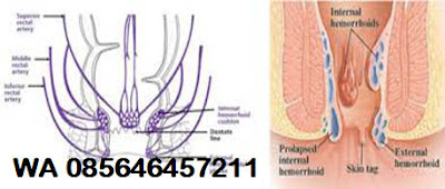 Obat Wasir Selain Venaron