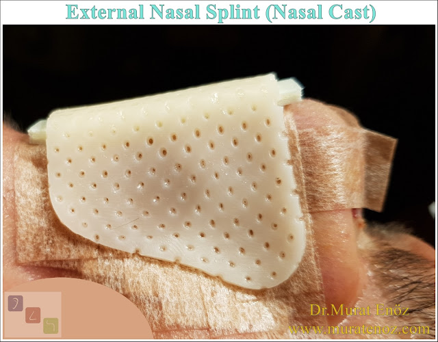 What Is The External Nasal Splint, Why it is Used and How Is It Taken Off?