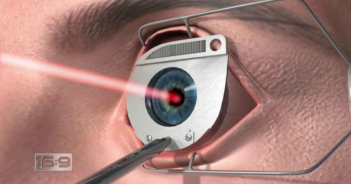 Sides Effects of Ocular Laser Surgery Sight Medical Blog