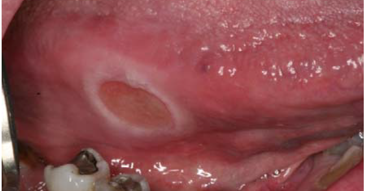 Study Medical Photos Description Of Mouth Ulcers With Pictures For Better Learning