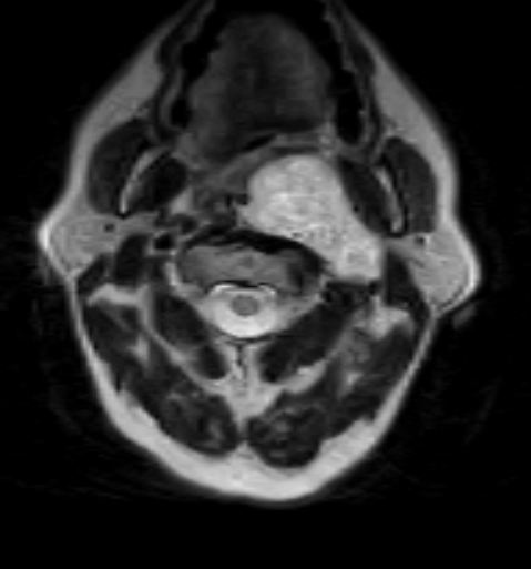 Carotid Body Tumour Mri Sumer S Radiology Blog