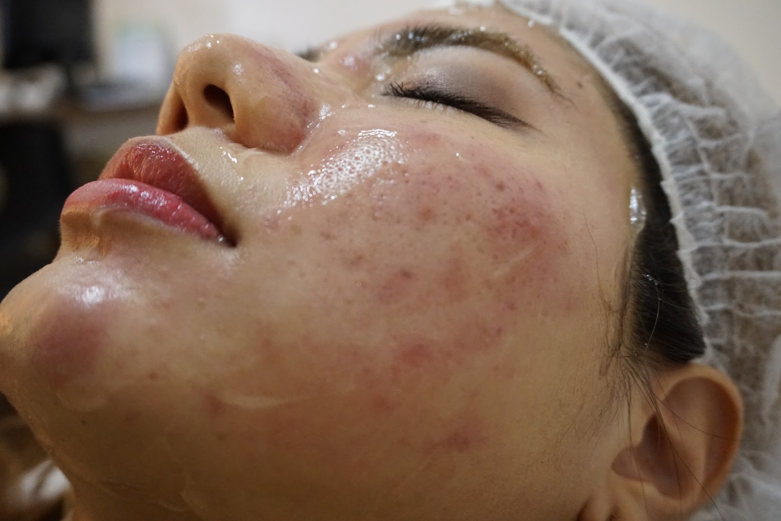 Laser for Acne Dual Yellow Laser Skin Gym SS2 J & D Learn to Blog