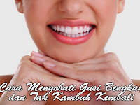 Cara Mengobati Gusi Bengkak dan Tak Kambuh Kembali Cara Mengobati Gusi Bengkak dan Tak Kambuh Kembali
