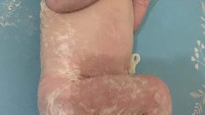 Mengenal Vernix Caseosa dan opini menyesatkan tentangnya.