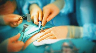 Operasi caesar Berawal dari Ritual