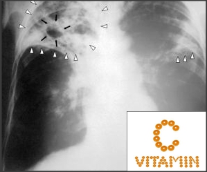 vitamin C can kill the bacteria Mycobacterium tuberculosis