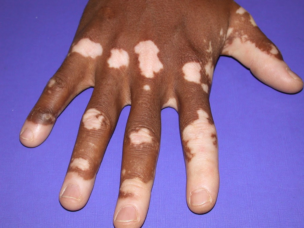 skin pigment diseases #10