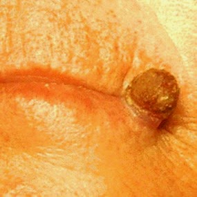 gambar kanker kulit