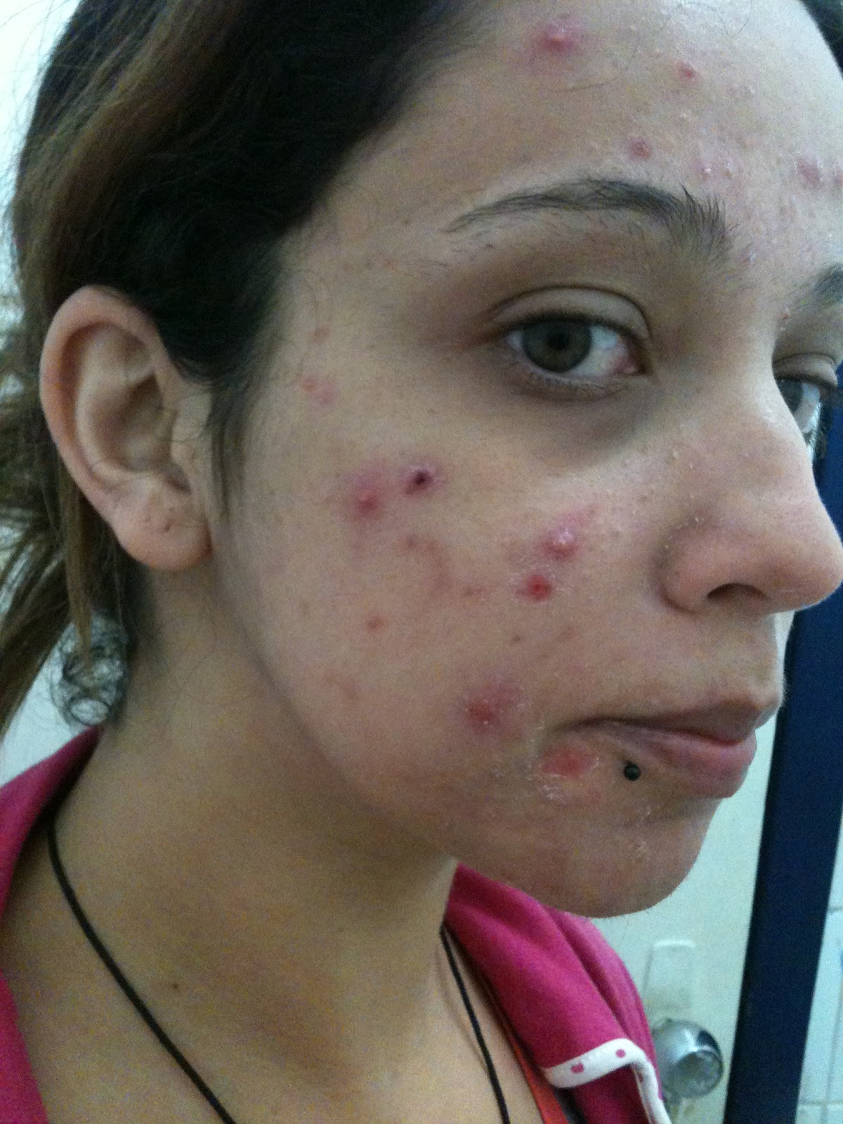 Diário de uma oncinha - Minha história com Roacutan: Abril 2013