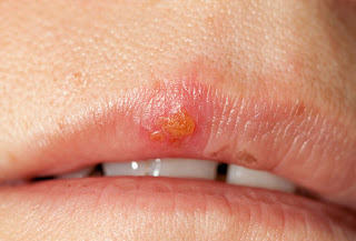 Como Curar Un Fuego En El Labio Como Curar Un Fuego En El Labio