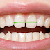 Niềng răng tại nhà có hiệu quả không?