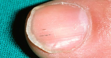 nail bed abnormalities - awesome