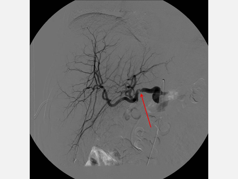 The Pump and the Tubes Hepatic Artery Complications Following Liver Transplant