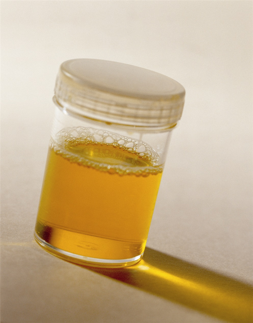 Kidney Diet and Health A Large Amount of Proteinuria Will Endanger Life?