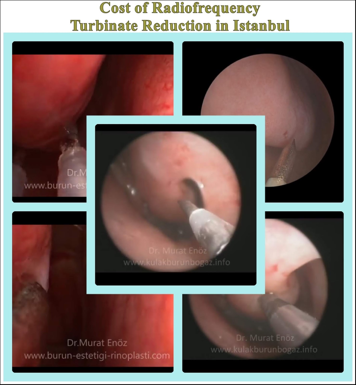 Cost Of Radiofrequency Turbinate Reduction In Istanbul Cost Of Radiofrequency Turbinate Reduction In Istanbul