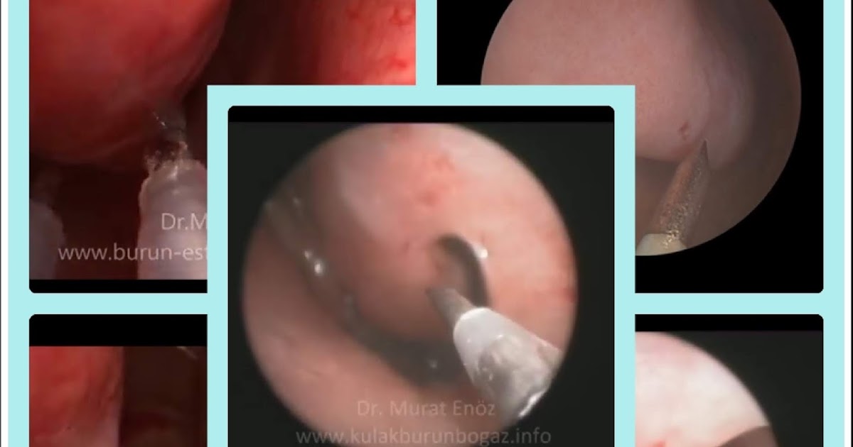Cost Of Radiofrequency Turbinate Reduction In Istanbul