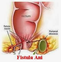 obat fistula ani paling ampuh tanpa operasi dan efek samping obat fistula ani paling ampuh tanpa operasi dan efek samping