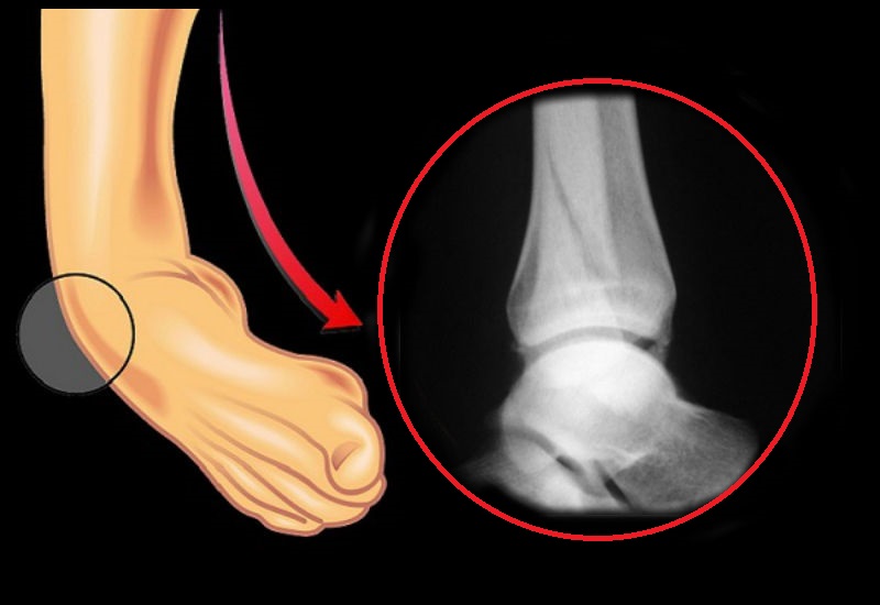 Fracturas dedos del pie