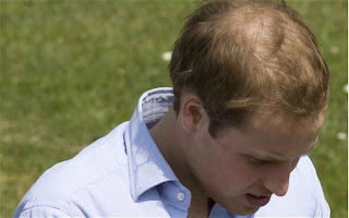 Androgenetic alopecia treatment | Male pattern baldness treatment