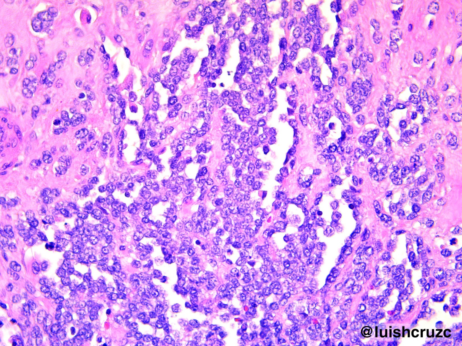 Patolog a CC Rabdomiosarcoma Alveolar Alveolar Rhabdomyosarcoma