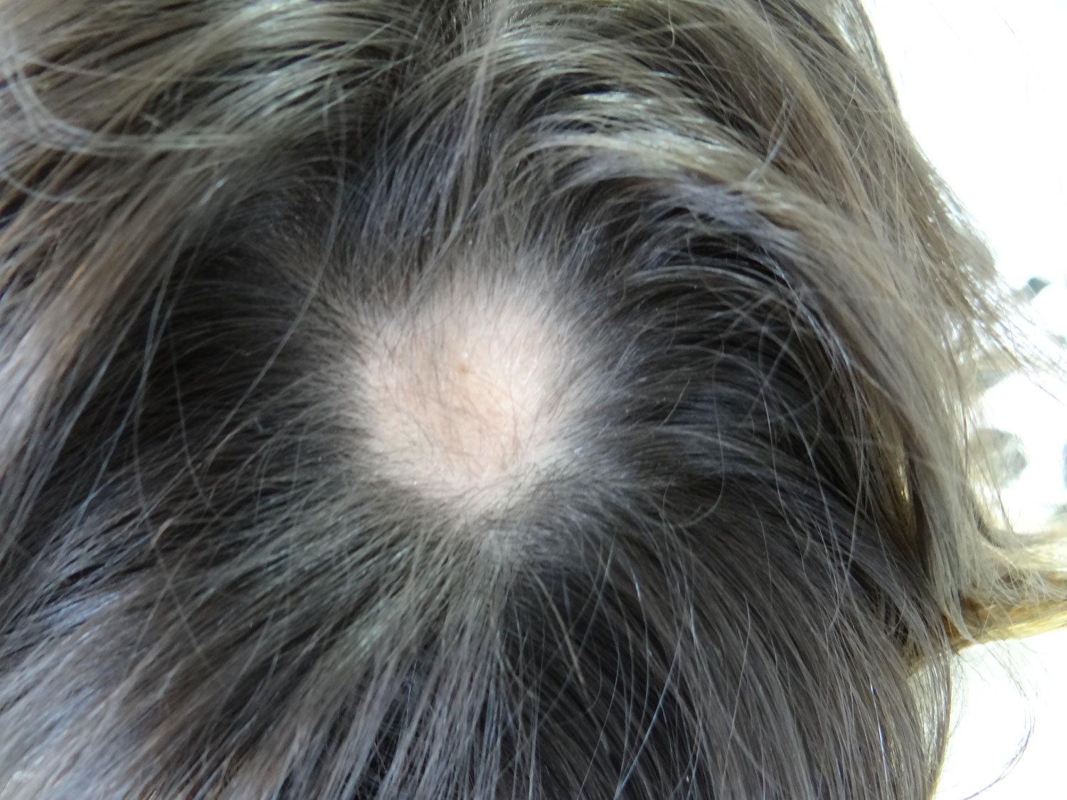 Tantos añadir Perezoso Alopecia areata: causas y tratamientos - Blog de Inma Vinue, farmacéutica