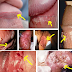 Obat Kutil Kelamin Di Apotik thumbnail