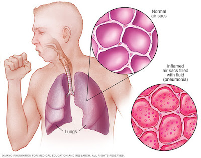 Gejala, Diagnosis, Etiologi, Faktor Resiko dan Komplikasi Penyakit Pneumonia