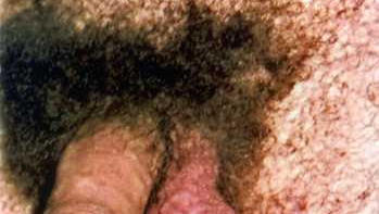 Tratamentul mumiilor din venelor varicoase