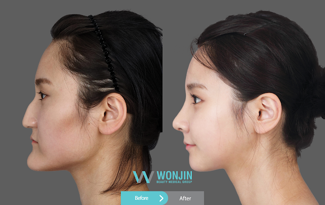 Two jaw surgery reivew before and After Photo Two jaw surgery reivew before and After Photo Hump After Nose Job