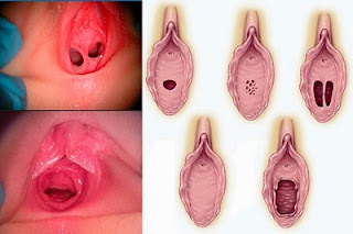 Thực hiện vá màng trinh xong có thể ra về trong ngày