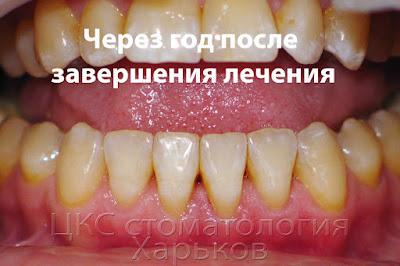 Результат лечения через год после удаления брекет системы Черные треугольники в конце лечения