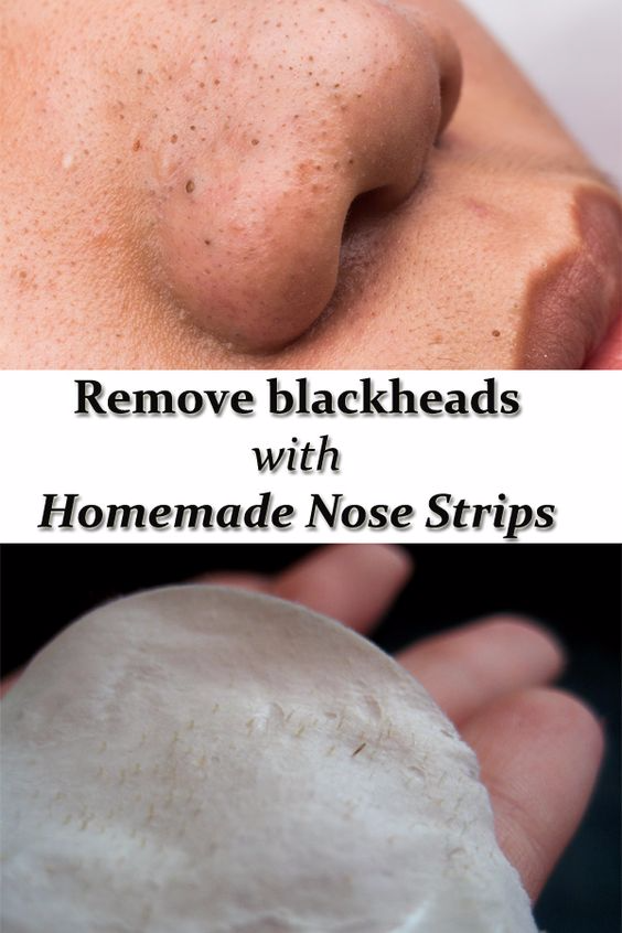 REMOVE BLACKHEADS WITH HOMEMADE NOSE STRIPS HEALTH AND DIY IDEAS