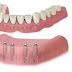 Răng implant tháo lắp là gì ?