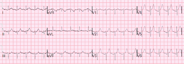 Dr Smith S Ecg Blog Chest Pain Sinus Tachycardia And St Elevation