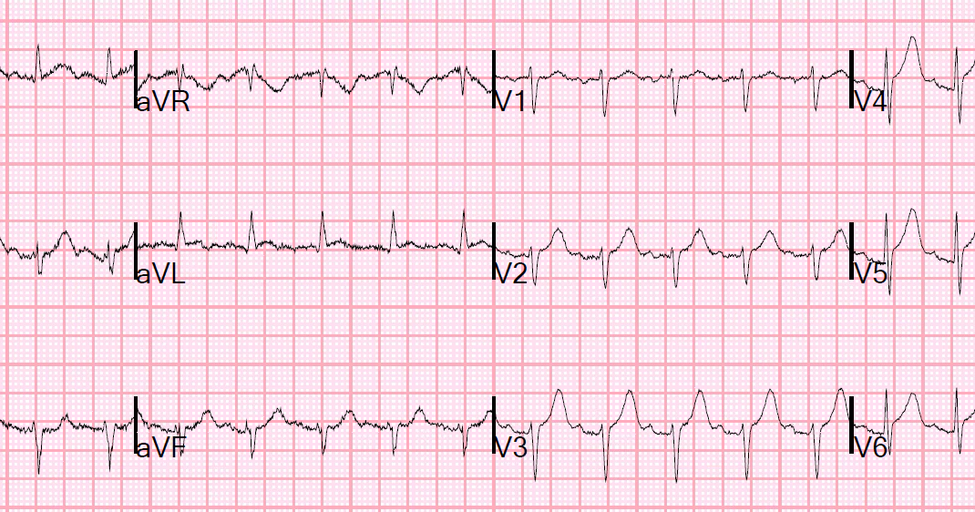 Dr Smith S Ecg Blog Chest Pain Sinus Tachycardia And St Elevation