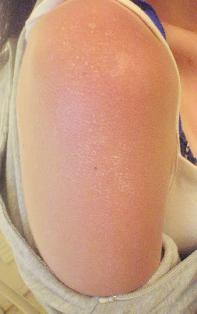 sunburned peeling skin