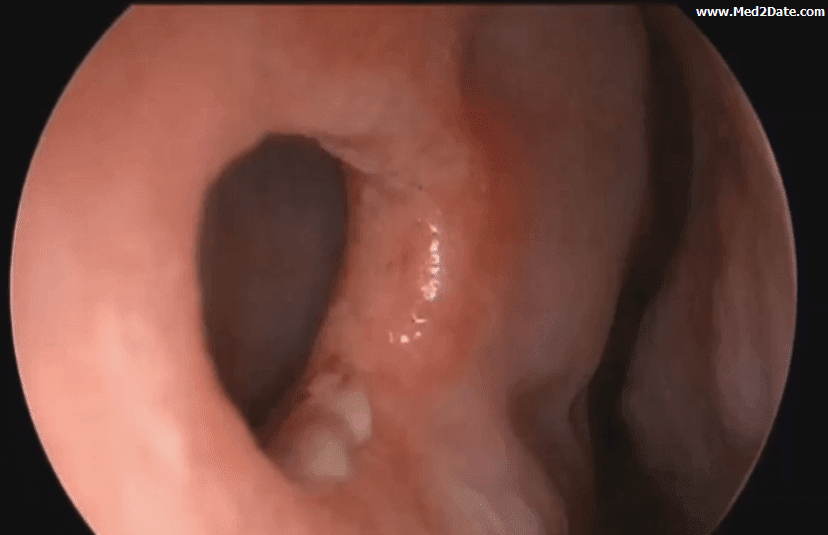 Nasal-septum-perforation
