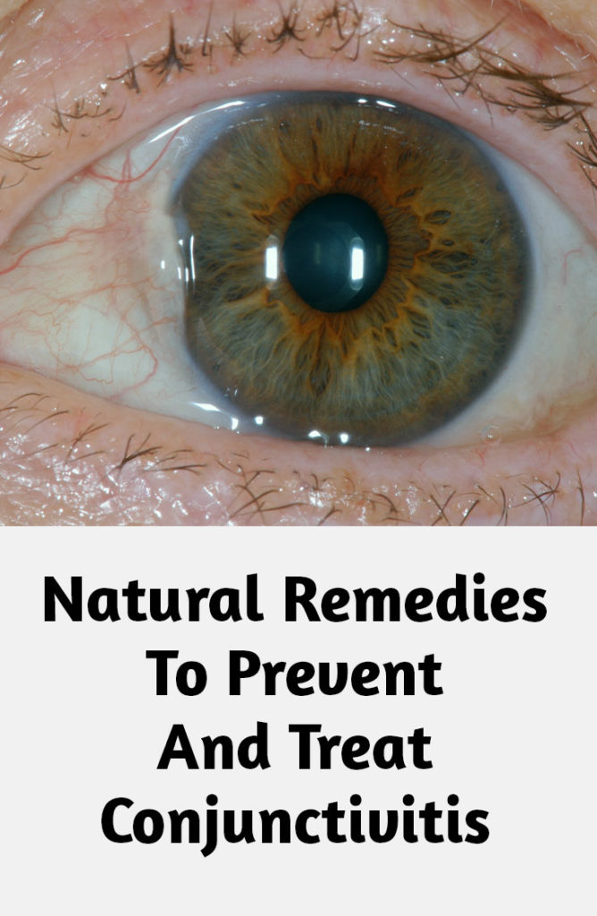 5 Natural Remedies To Prevent and Treat Conjunctivitis Health Fitness
