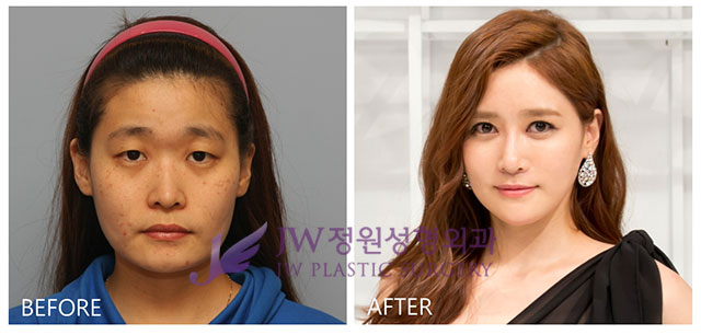 Có thể phẫu thuật thẩm mỹ thay đổi toàn diện khuôn mặt