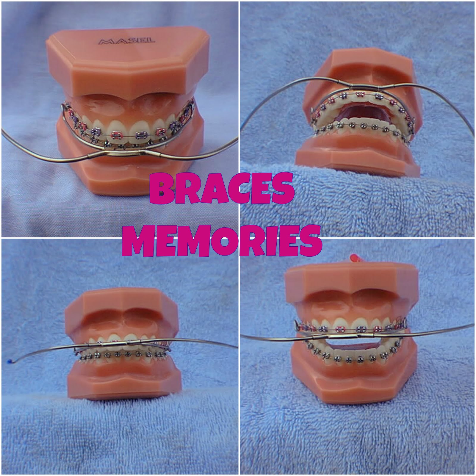 Braces Memories Braces In The '80s